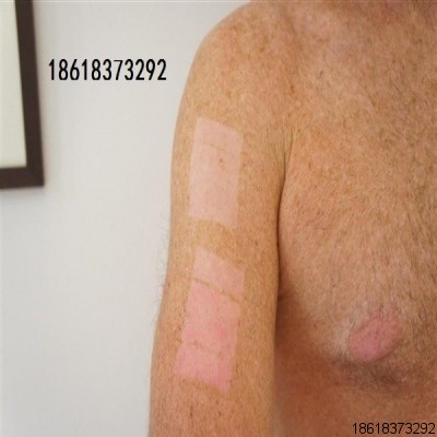 強(qiáng)脈沖光真OPT的辨別，附大量實(shí)例對(duì)比